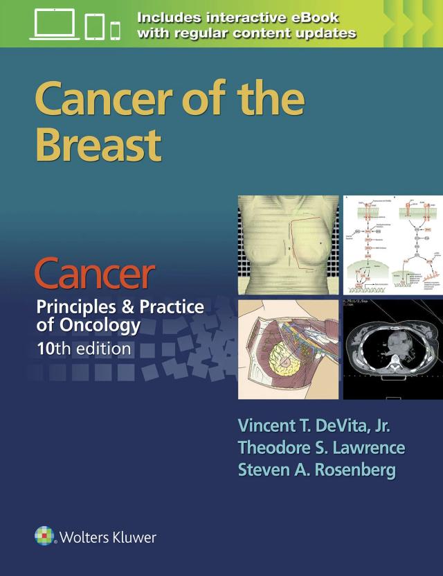 Cancer of the breast