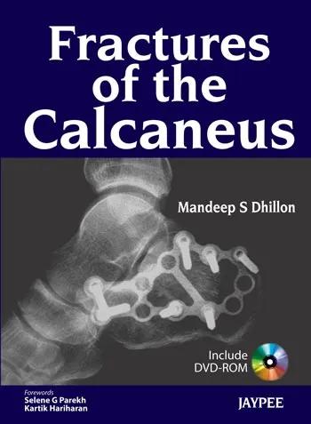 Fractures of The Calcaneus with Dvd-rom - 1st Edition