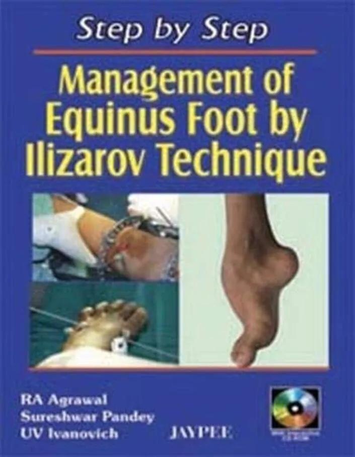 Step by Step Management of Equinus Foot by Ilizarov Technique With Cd Rom