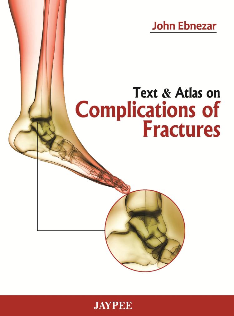 Text and Atlas on Complications of Fractures - 1st Edition