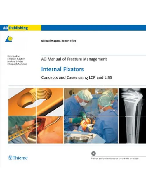 AO Manual of Fracture Management Internal Fixators - 1st Edition Indian Reprint