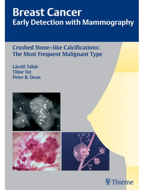 Breast Cancer: Early Detection with Mammography, Crushed Stone-like Calcifications The Most Frequen - 1st Edition