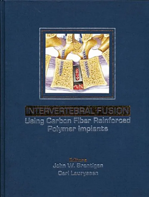 Intervertebral Fusion Using Carbon Fiber Reinforced Polymer Implants - 1st Edition