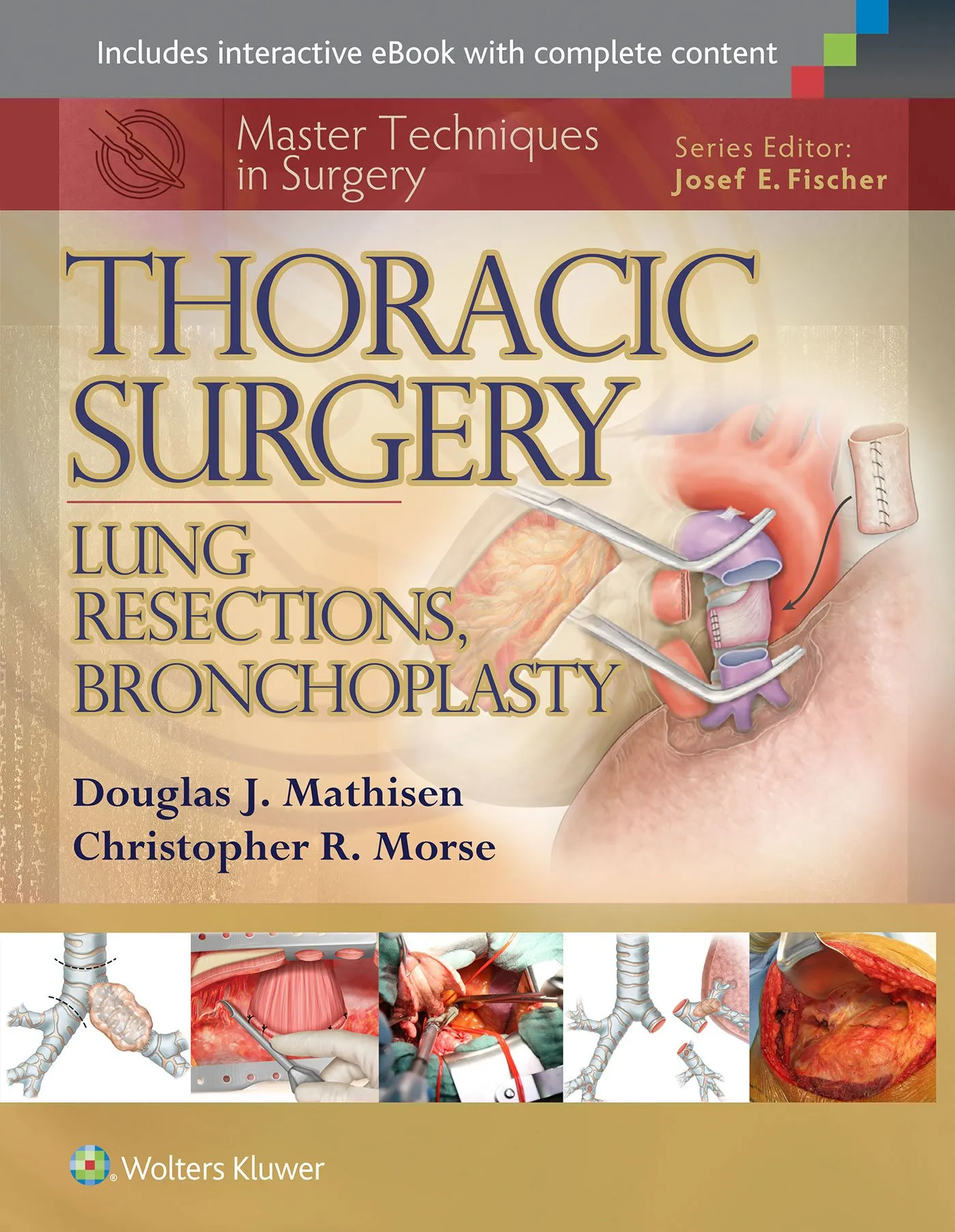 Master Techniques in Surgery: Thoracic Surgery: Lung Resections, Bronchoplasty -2nd Edition