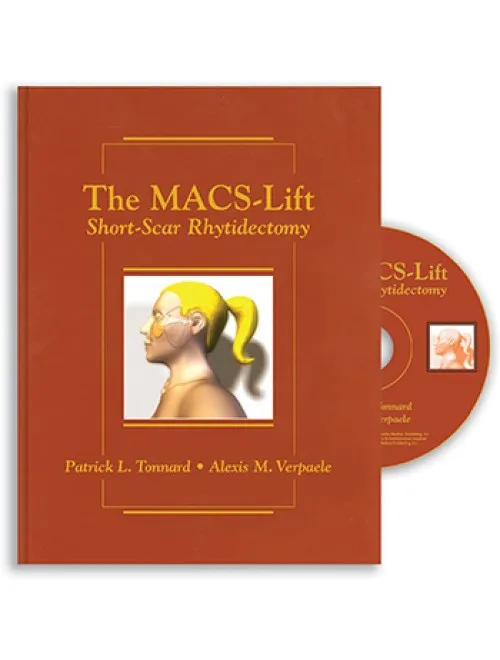 The MACS-Lift Short-Scar Rhytidectomy - 1st Edition