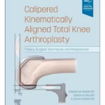 Calipered Kinematically aligned Total Knee Arthroplasty-1st Edition