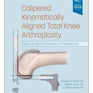 Calipered Kinematically aligned Total Knee Arthroplasty-1st Edition