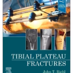 Tibial Plateau Fractures-1st Edition
