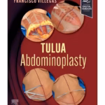 TULUA Abdominoplasty: Transverse Plication Technique - 1st Edition