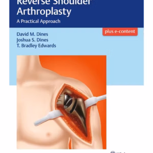 Reverse Shoulder Arthroplasty 1st Edition