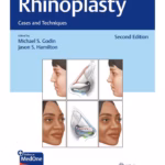 Rhinoplasty 2nd Edition
