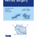 Hernia Surgery 1st Ed.