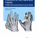 Fractures of the Hand and Carpus Fessh 2018 Instructional Course Book