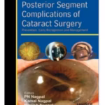 Posterior Segment Complications Of Cataract Surgery Prev.,Early Recog.And Management