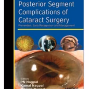 Posterior Segment Complications Of Cataract Surgery Prev.,Early Recog.And Management