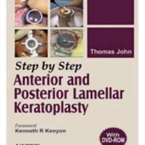 Step By Step Anterior And Posterior Lamellar Keratoplasty(With Dvd)