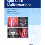 Split Cord Malformations 1st Ed.