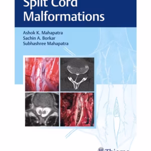 Split Cord Malformations 1st Ed.