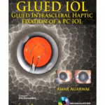 Glued Iol Glued Intrascleral Haptic Fixation Of A Pc Iol With Dvd-Rom