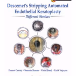 Descemet'S Stripping Automated Endothelial Keratoplasty:Different Strokes