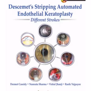 Descemet'S Stripping Automated Endothelial Keratoplasty:Different Strokes