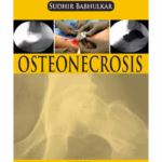 Osteonecrosis