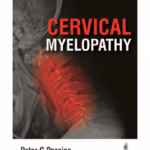 Cervical Myelopathy