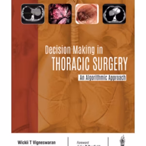 Decision Making In Thoracic Surgery An Algorithmic Approach