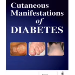 Cutaneous Manifestations Of Diabeties