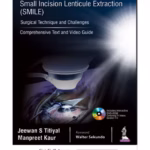 Small Incision Lenticule Extraction (Smile) Surgical Technique And Challenges:Comprehensive Text