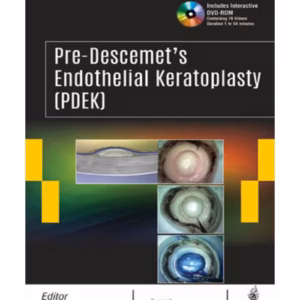 Pre-Descemet'S Endothelial Keratoplasty(Pdek)
