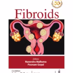 Fibroids