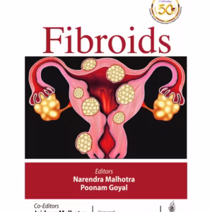 Fibroids