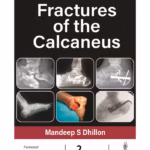 Fractures Of The Calcaneus