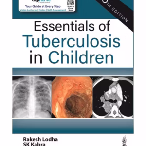 Essentials Of Tuberculosis In Children
