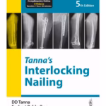 Tanna'S Interlocking Nailing