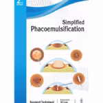 Simplified Phacoemulsification