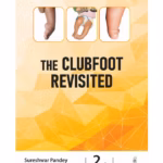The Clubfoot Revisited