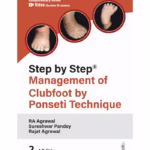 Step By Step Management Of Clubfoot By Ponseti Technique