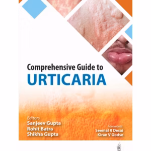 Comprehensive Guide To Urticaria