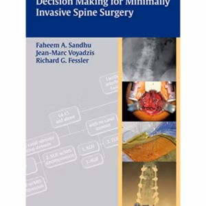 Decision Making for Minimally Invasive Spine Surge Indian Reprint