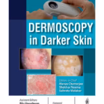 Dermoscopy In Darker Skin
