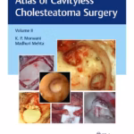 Atlas of Cavityless Cholesteatoma Surgery (Volume 2)