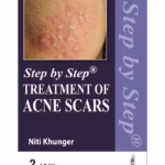 Step By Step Treatment Of Acne Scars