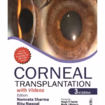 Corneal Transplantation